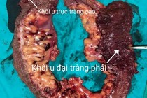 Ca ung thư đại tràng 2 vị trí 