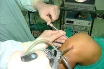 Biến chứng sau mổ tái tạo dây chằng chéo 