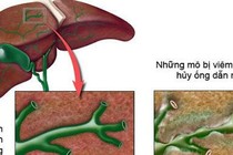  Vàng da, sốt do viêm đường mật xơ hóa