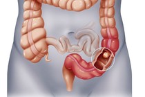 Tắc ruột do yếu tố thần kinh 