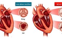 Hở van tim có cần điều trị?