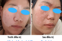 Ghép tế bào gốc tự thân điều trị bạch biến