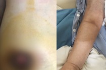 Phù tay, loét vú vì đắp lá chữa u