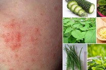 Nhiễm độc da do tắm lá trị rôm 