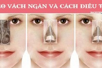  Vẹo vách ngăn vì chủ quan với nghẹt mũi 