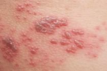 Các bài thuốc Đông y cho từng thể bệnh zona thần kinh