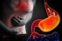 Trào ngược dạ dày khi nào phải phẫu thuật 