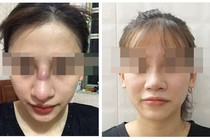 Áp xe sau nâng mũi thẩm mỹ