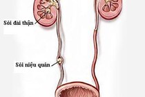  Bệnh sỏi thận có nguy hiểm?