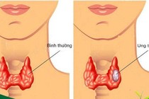 Điều trị từng thể ung thư tuyến giáp