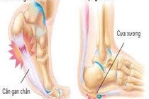 Đau gót chân có phải gai xương