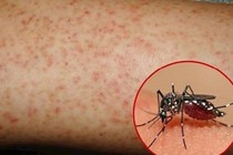 Dấu hiệu của bệnh sốt xuất huyết 
