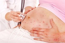 Nghi sốt do rubella khi mang thai