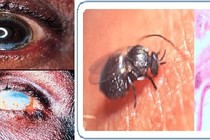 Cẩn thận ký sinh trùng gây mù mắt