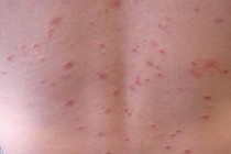 Phải làm sao khi mắc vảy nến thể giọt?