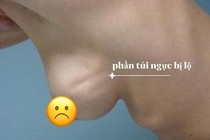 Nâng ngực bị lộ túi