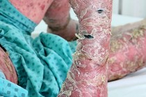  Điều trị bệnh vảy nến bằng thuốc sinh học