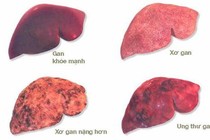 U gan giàu mạch