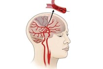 Nhồi máu não diện rộng là gì? Điều trị bằng cách nào?