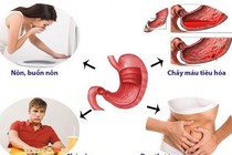  Loét dạ dày do bỏ bữa sáng