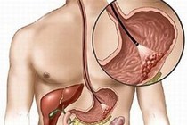 Cắt u carcinoid đường tiêu hóa qua nội soi ống mềm 