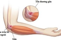  Tay đau khó gấp duỗi do viêm mỏm trên lồi cầu