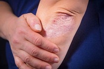 Bệnh vảy nến toàn thân và cách cải thiện hiệu quả