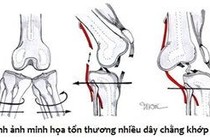 Tổn thương lại dây chằng chéo