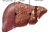 Gan nhiễm mỡ kèm xơ gan do rượu
