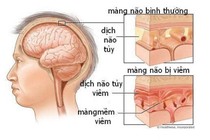  Viêm màng não lại tưởng sốt virus