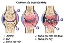 Loãng xương là nguyên nhân gây thoái hóa khớp gối