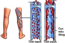 Thuốc chống đông nhóm đối kháng vitamin K
