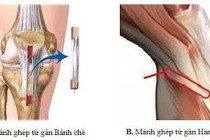 Lấy gân tái tạo dây chằng chéo sau