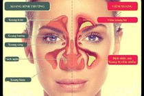 Viêm xoang trước cấp