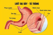  9 tuổi đã viêm loét dạ dày, hành tá tràng do vi khuẩn HP 