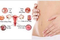 Viêm phụ khoa từ thói quen sạch sẽ