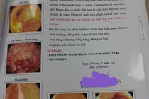  3 lần sinh thiết mới phát hiện u lympho