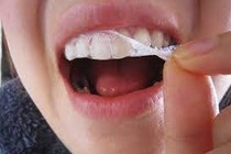 Tẩy trắng răng siêu tốc rất độc hại