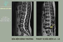 Cần lưu ý khi thoát vị đĩa đệm gây tê tay, chân 