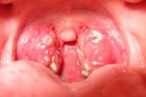 Trẻ ngủ ngáy cẩn thận viêm amidan quá phát 