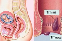 Nguy cơ mắc trĩ khi mang thai