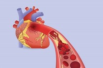 Dùng thuốc Nam có tránh tái phát nhồi máu cơ tim?