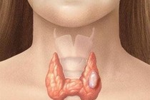 Bệnh u tuyến giáp lành tính và những thông tin bạn cần biết