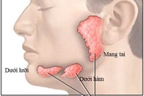 Viêm tuyến nước bọt sau uống xạ 