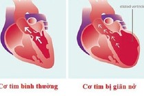 Mối nguy hiểm do bệnh cơ tim giãn