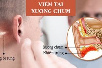 Nguy hiểm tính mạng vì chủ quan với viêm tai xương chũm