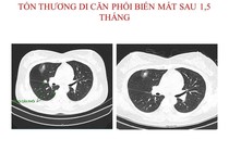 Hết u phổi và u não di căn sau 1,5 tháng điều trị