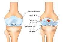 Ai dễ mắc viêm khớp gối? 