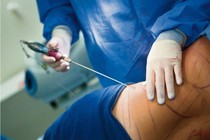 Tử vong vì sốc nhiễm trùng sau hút mỡ bụng