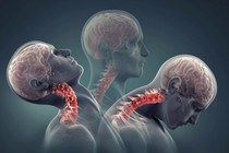 1 số dấu hiệu chỉ điểm bạn đã thoát vị đĩa đệm, thoái hóa cột sống cổ